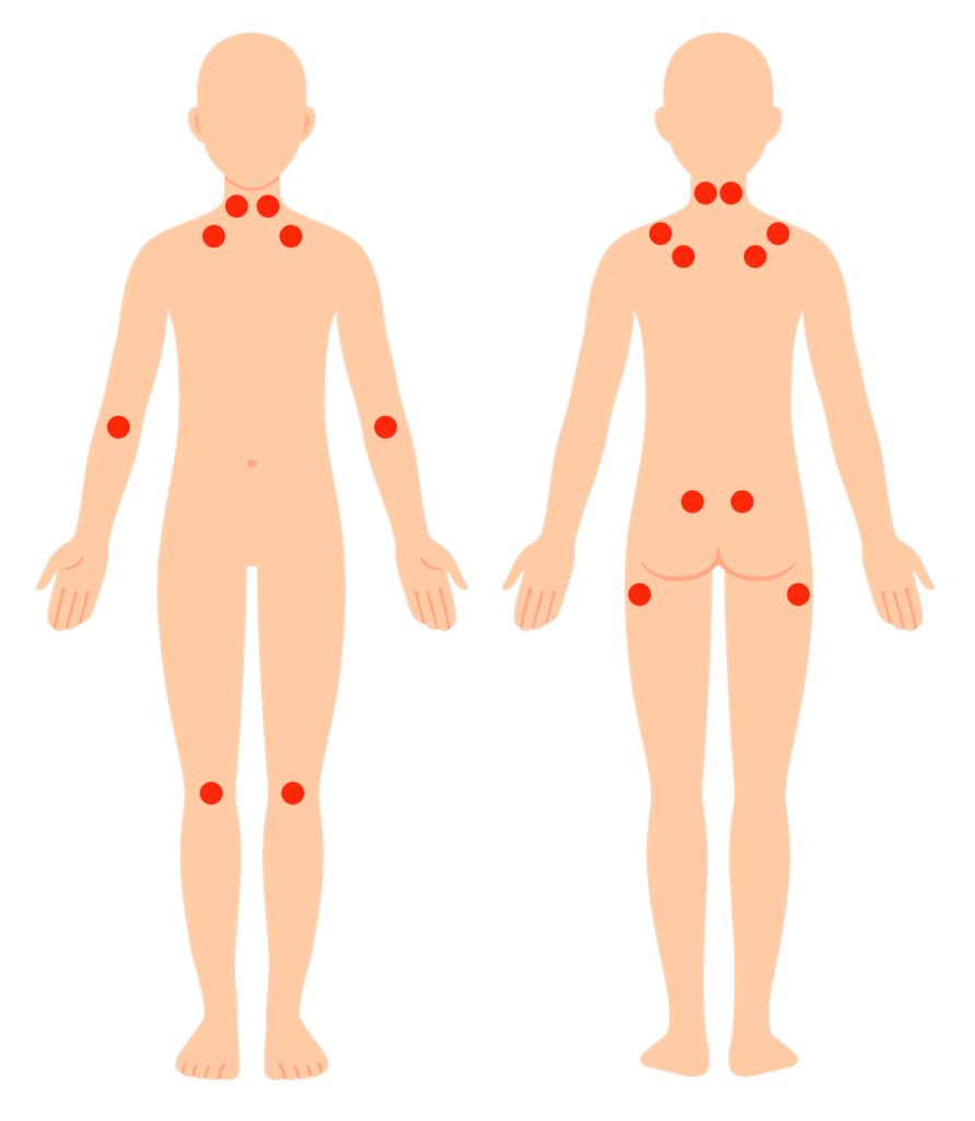 Fibromyalgi tenderpoints