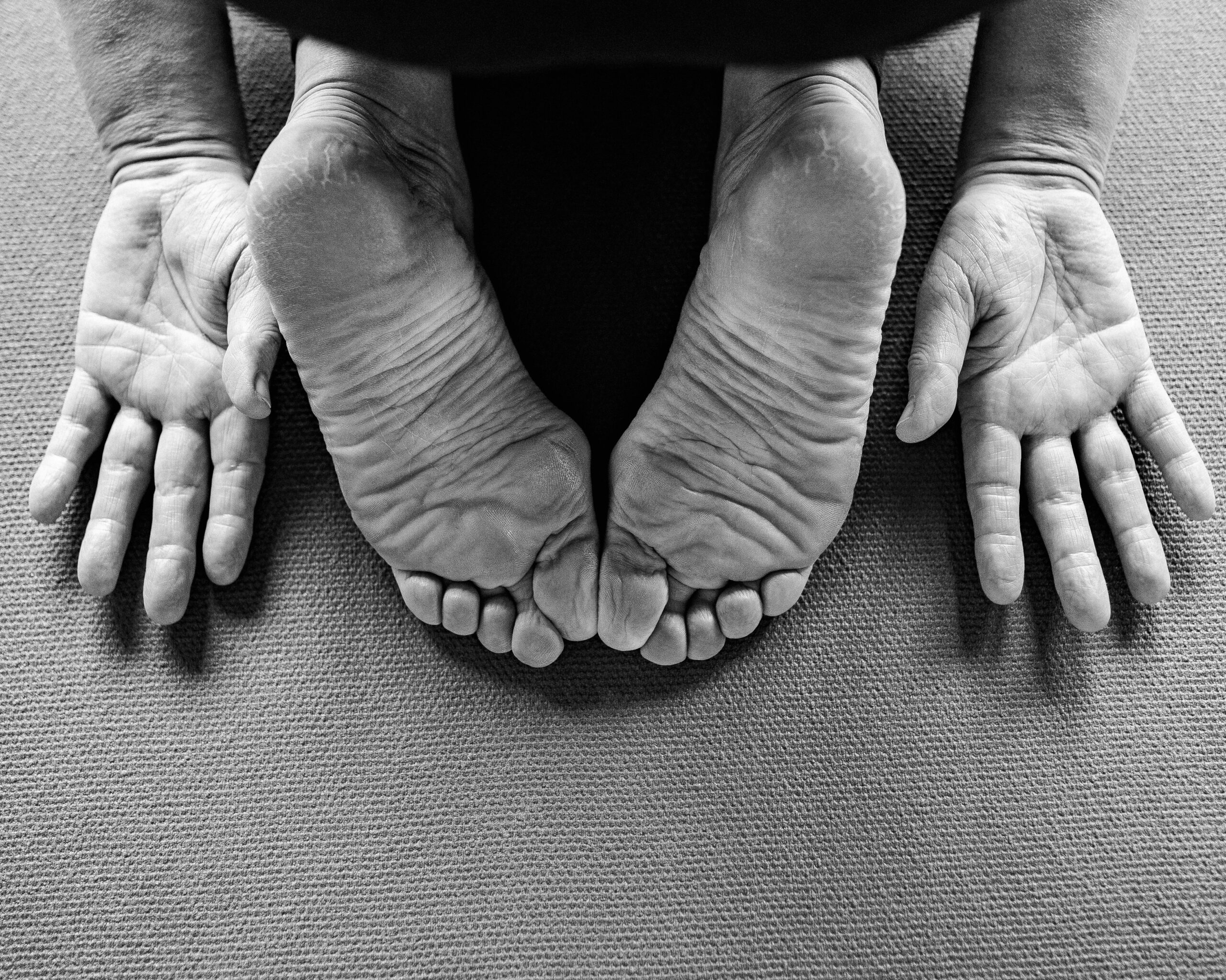 Prikken og snurren i hænder og fødder ved fibromyalgi